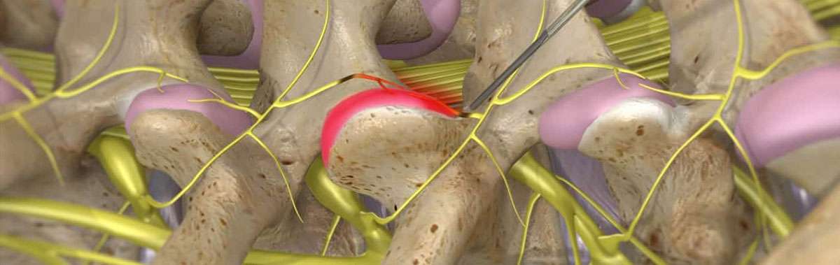 lumbar-medial-branch-blocks-pain-clinic-sydney-painmed